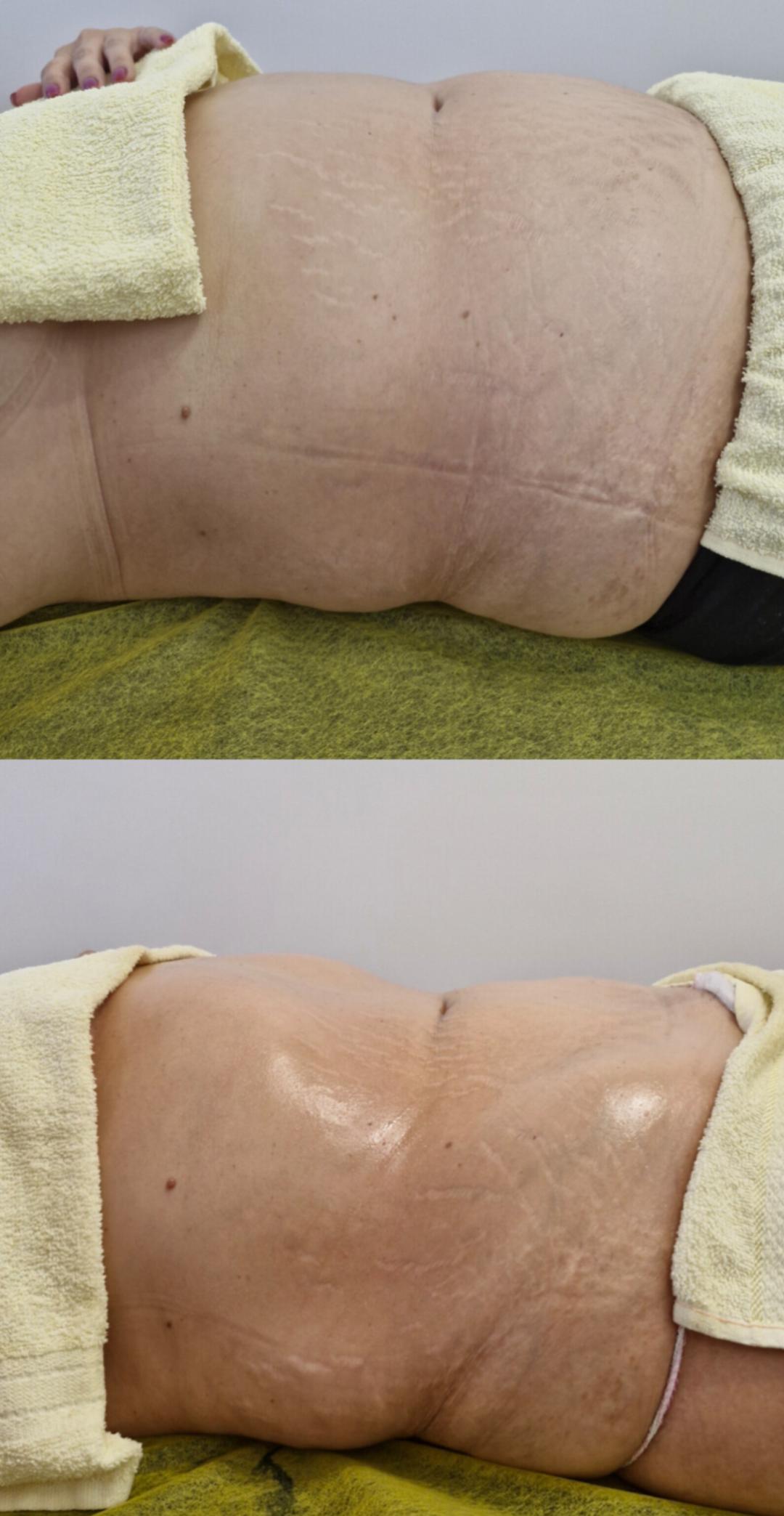 Body shaping PRO po regiji - paket od 5 tretmana - Apolona, Beograd Lipomodelovanje Telo Lipomodelovanje, Beograd, Banovo brdo