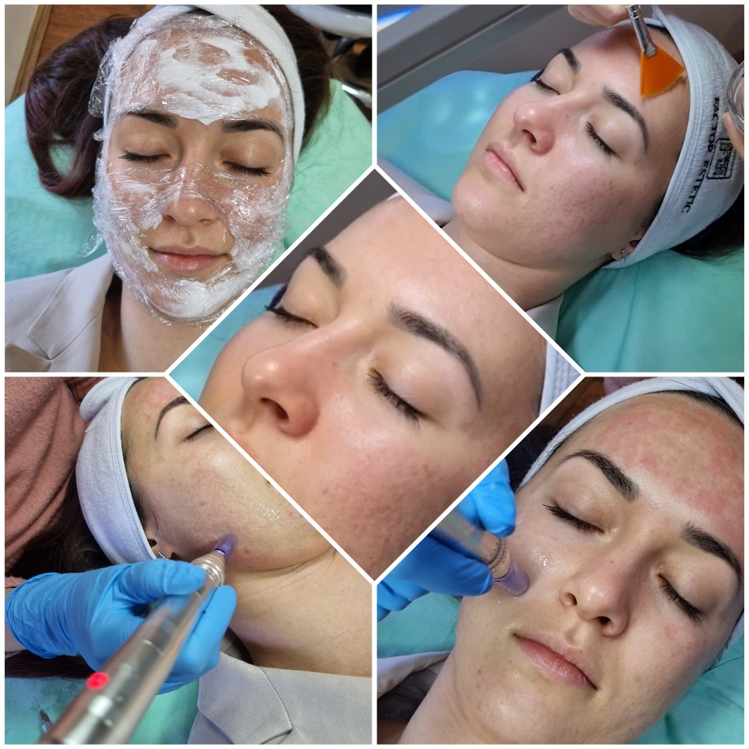 Emilly #beograd Dermaroler i dermapen Dermapen