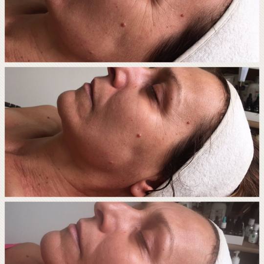 La Beauté #beograd Lift tretman pre/posle 1/posle 10og tretmana