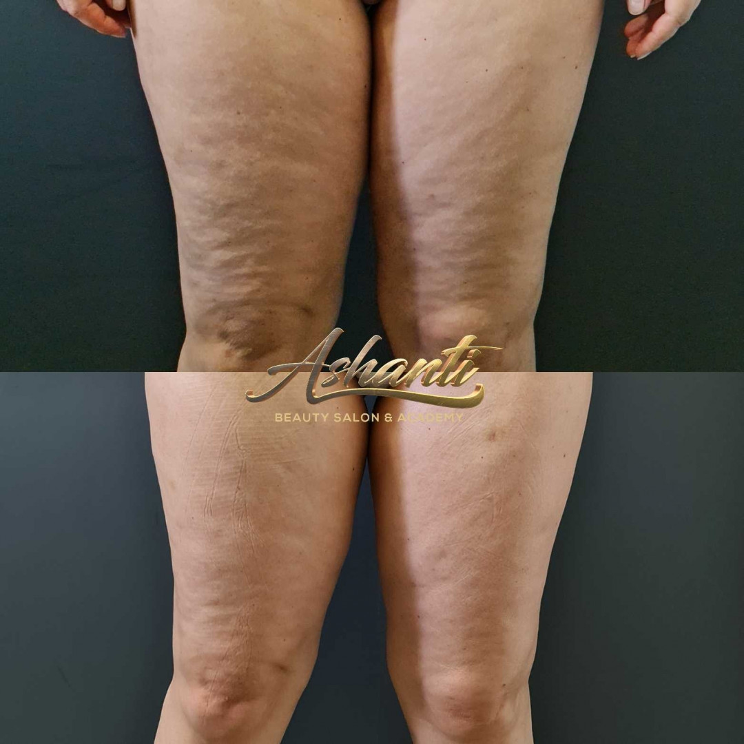 Ashanti Beauty Salon & Academy #beograd Masaža za mršavljenje Dermapen - regija lica