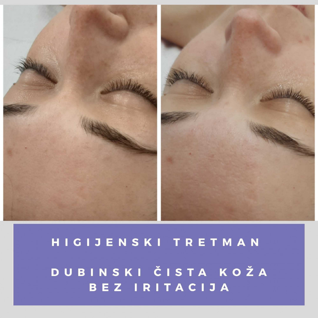 Felicita #beograd Hijaluronski tretmani lica Higijenski tretman lica
