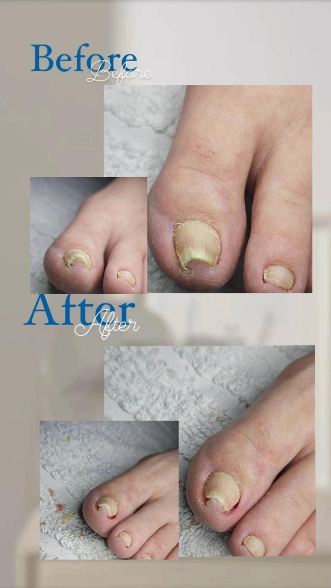 Medicinski pedikir - više problematičan - Princess beauty, Niš Medicinski pedikir Nokti Medicinski pedikir, Niš, Palilula