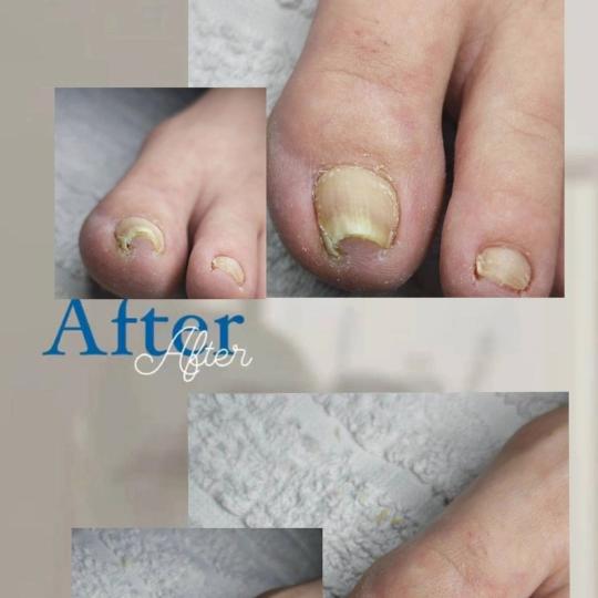 Princess beauty #nis Medicinski pedikir Medicinski pedikir - više problematičan