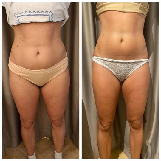 Nirvana Health and Beauty Studio #beograd Fitness Vela Shape tretman - stomak Vela Perfekt Shaper-10