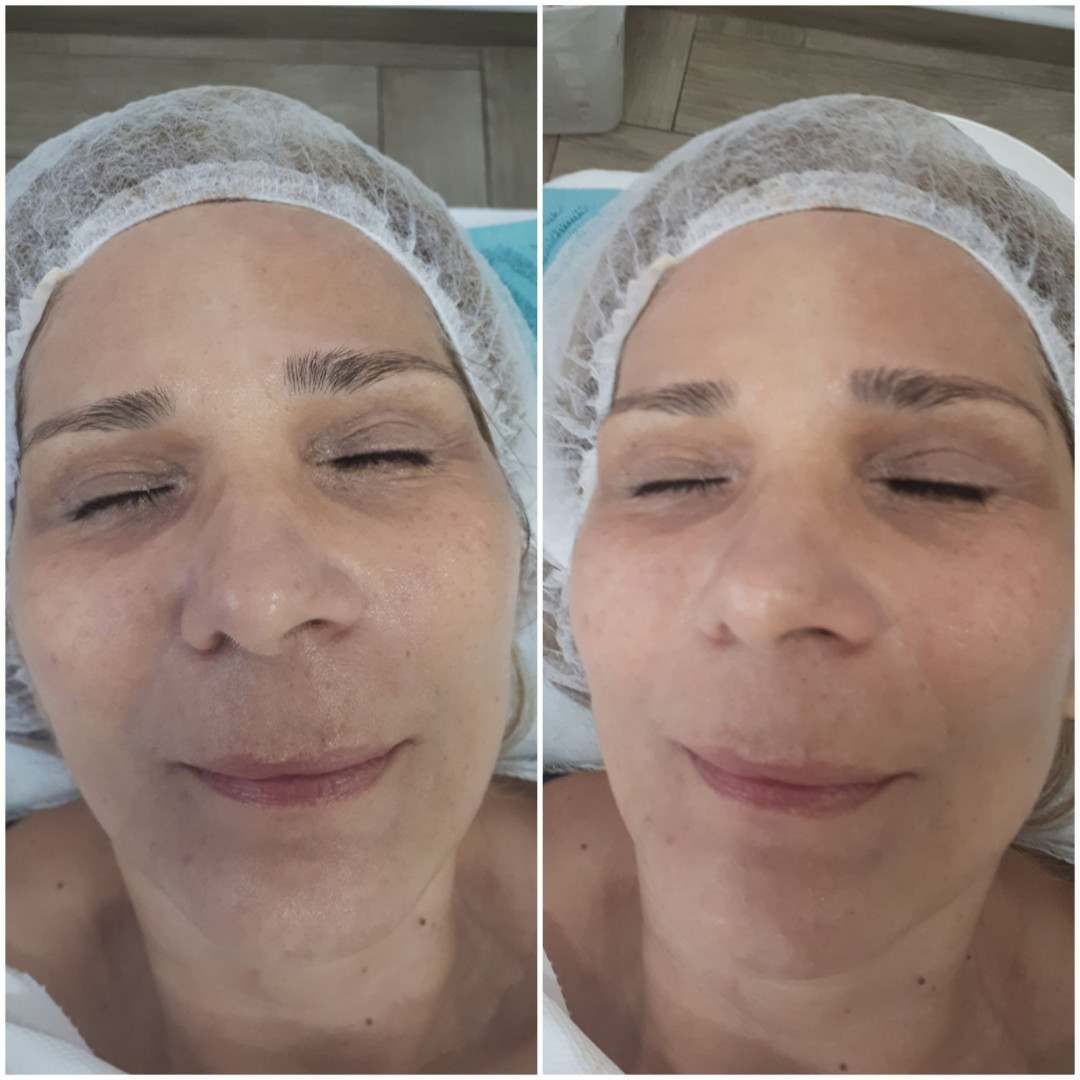 Essence of Beauty Academy #beograd Tretman lica Karbonski tretman lica