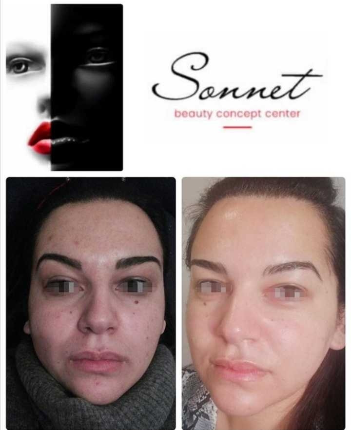Sonnet beauty concept center #beograd Mezoterapija lica Mezoterapija - Mesoglow