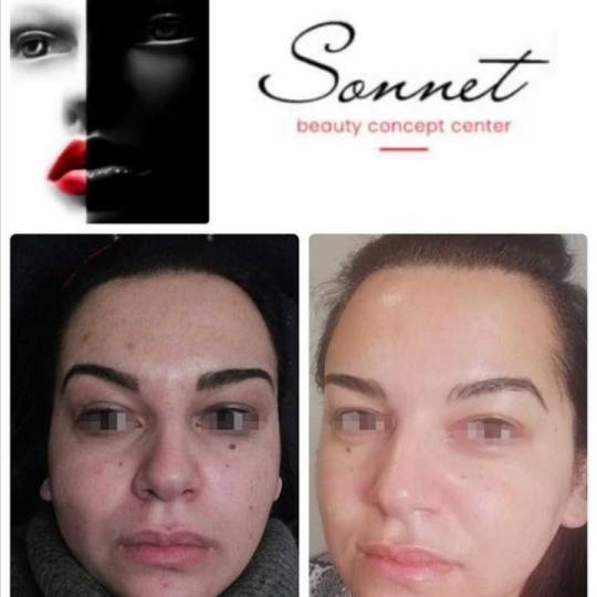 Sonnet beauty concept center #beograd Mezoterapija lica Mezoterapija - Mesoglow ?Mezoterapija? je 