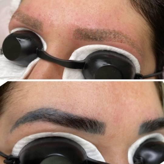 Laser centar Delight #beograd Trajna šminka Uklanjanje trajne šminke laserom obrva ili usana Razlo