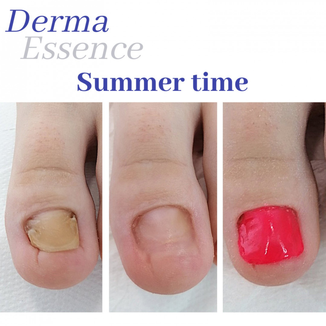 Derma Essence #nis Medicinski pedikir Nadogradnja nokta antimikotičnim gelom