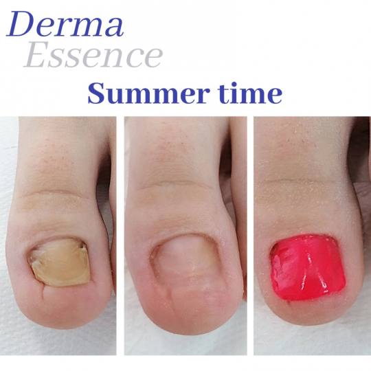 Derma Essence #nis Medicinski pedikir Nadogradnja nokta antimikotičnim gelom