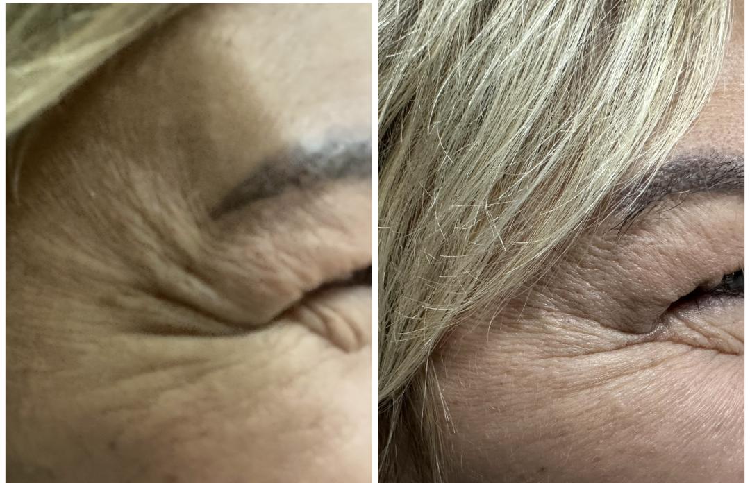 Botox - 3 regije - Beauty & Fashion, Beograd Botox Lice Botox, Beograd, Mirijevo