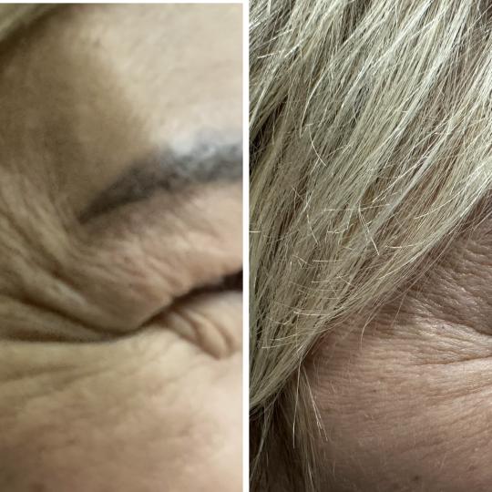 Beauty & Fashion #beograd Botox Botox - 3 regije BOTOX – prirodan izgled, svežina bez gubitka mim