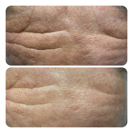 Prestige #beograd Tretman lica Biorevitalizacija lica