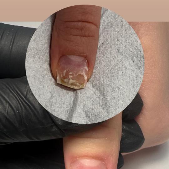 Belle Ana #beograd Tretmani tela Lasersko uklanjanje gljivica noktiju Lasersko uklanjanje gljivica n