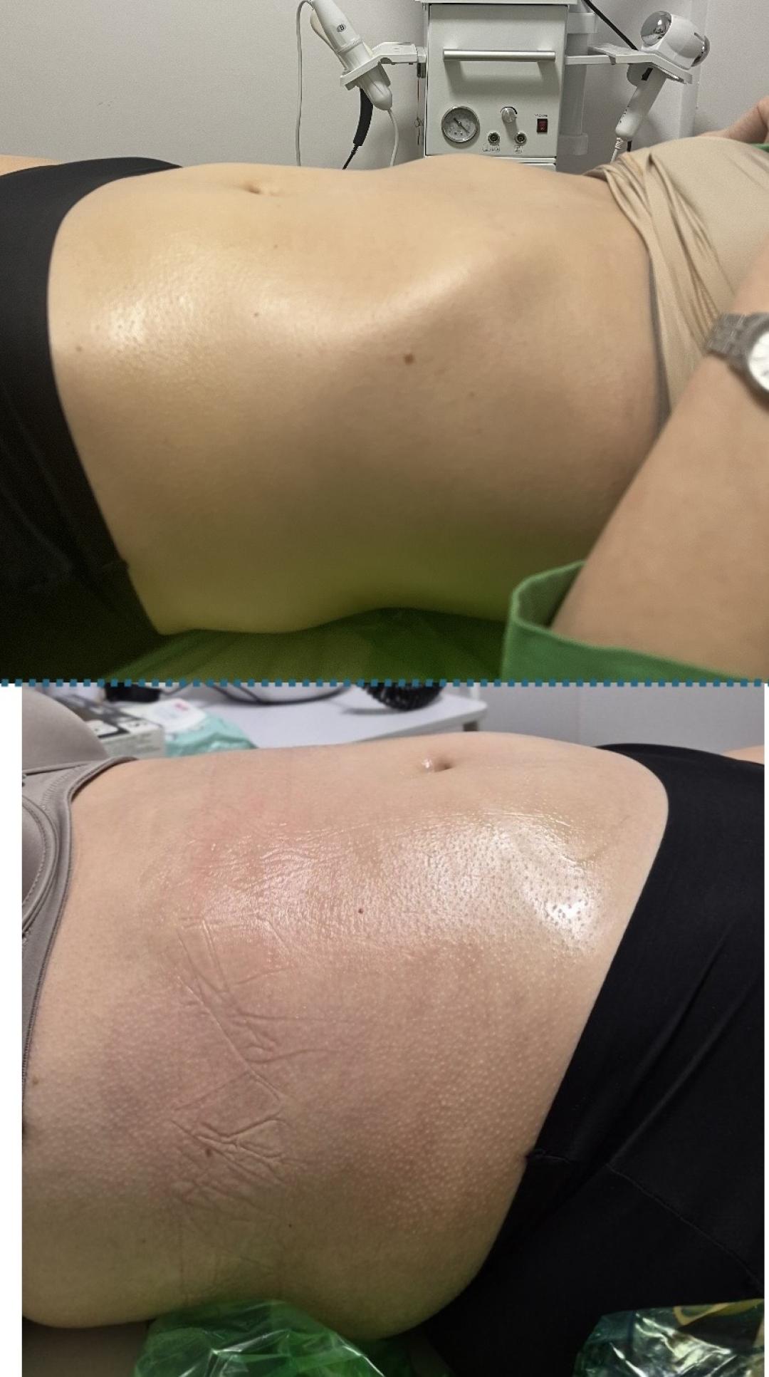 Vacum65body+lipomodelovanje jedne regije - Diamond beauty, Beograd Anticelulit masaža Masaža Anticelulit masaža, Beograd, Zemun Centar