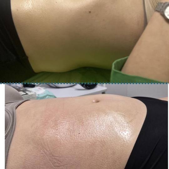 Diamond beauty #beograd Anticelulit masaža Vacum65body+lipomodelovanje jedne regije