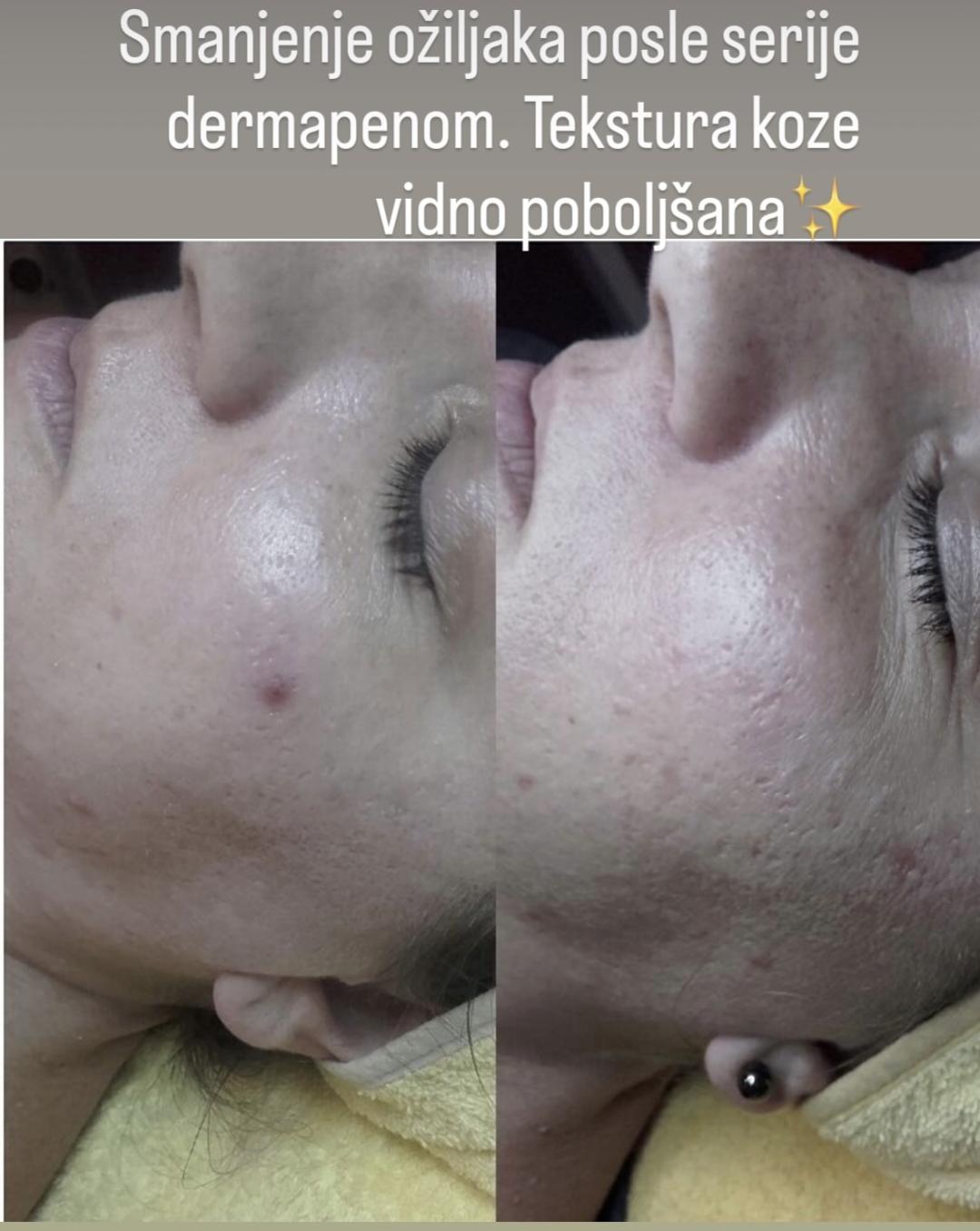 Dermapen tretman lica - Petra beauty concept, Beograd Dermaroler i dermapen Lice Dermaroler i dermapen, Beograd, Vračar, Čubura, Crveni krst
