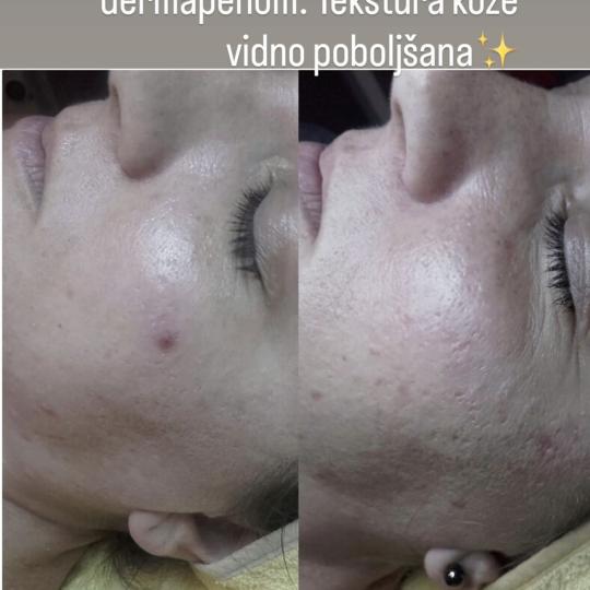 Petra beauty concept #beograd Dermaroler i dermapen Dermapen tretman lica