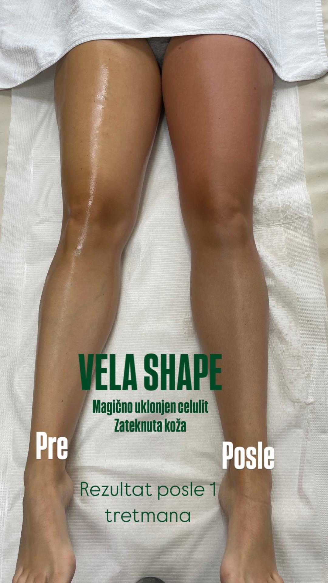 Velashape III - butina - GM Beauty studio, Beograd Anticelulit masaža Masaža Anticelulit masaža, Beograd, Banovo brdo