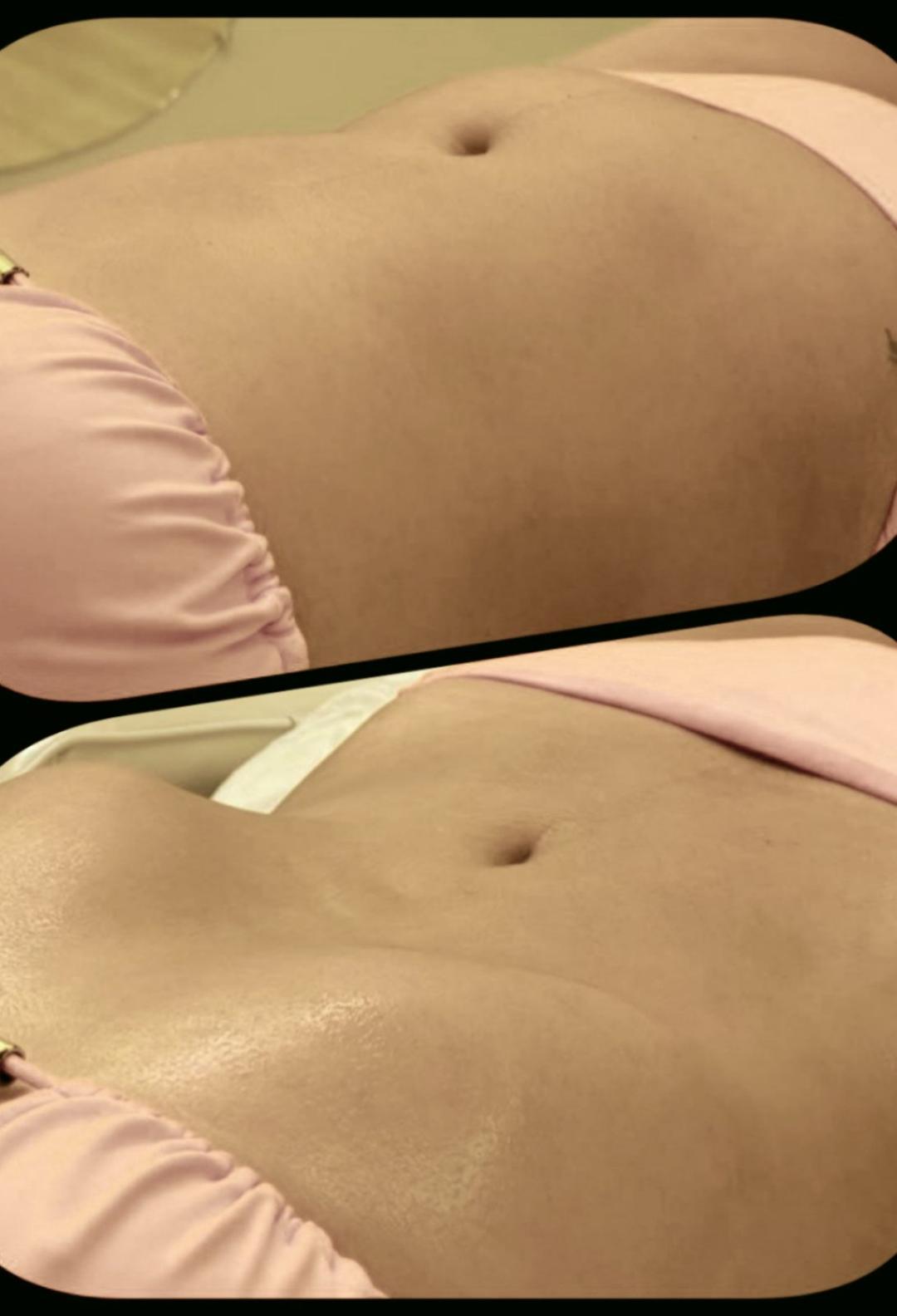 Happy in your body #beograd Tretmani tela Limfomodeliranje - stomak