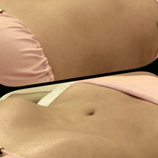 Happy in your body #beograd Tretmani tela Limfomodeliranje - stomak