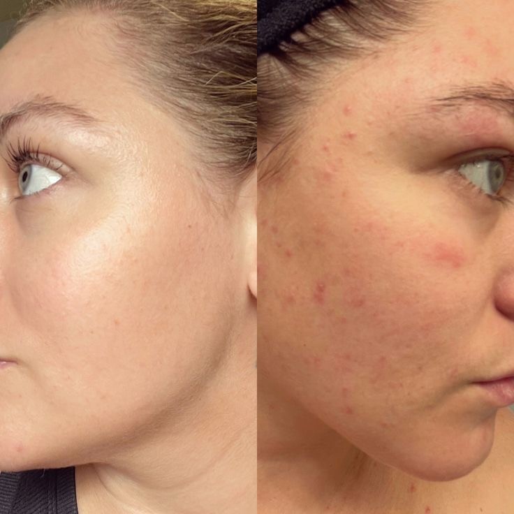 Xenija Beauty Room #beograd Tretman lica Dermapen tretman lica - paket od 4 tretmana + 1 gratis