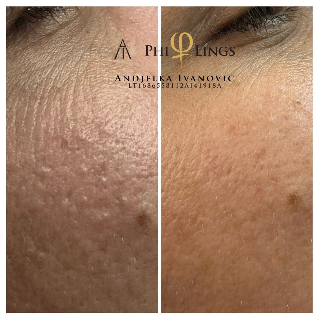 Microneedling tretman - lice - Belle Ana, Beograd Tretman lica Lice Tretman lica, Beograd, Vračar, Čubura, Crveni krst