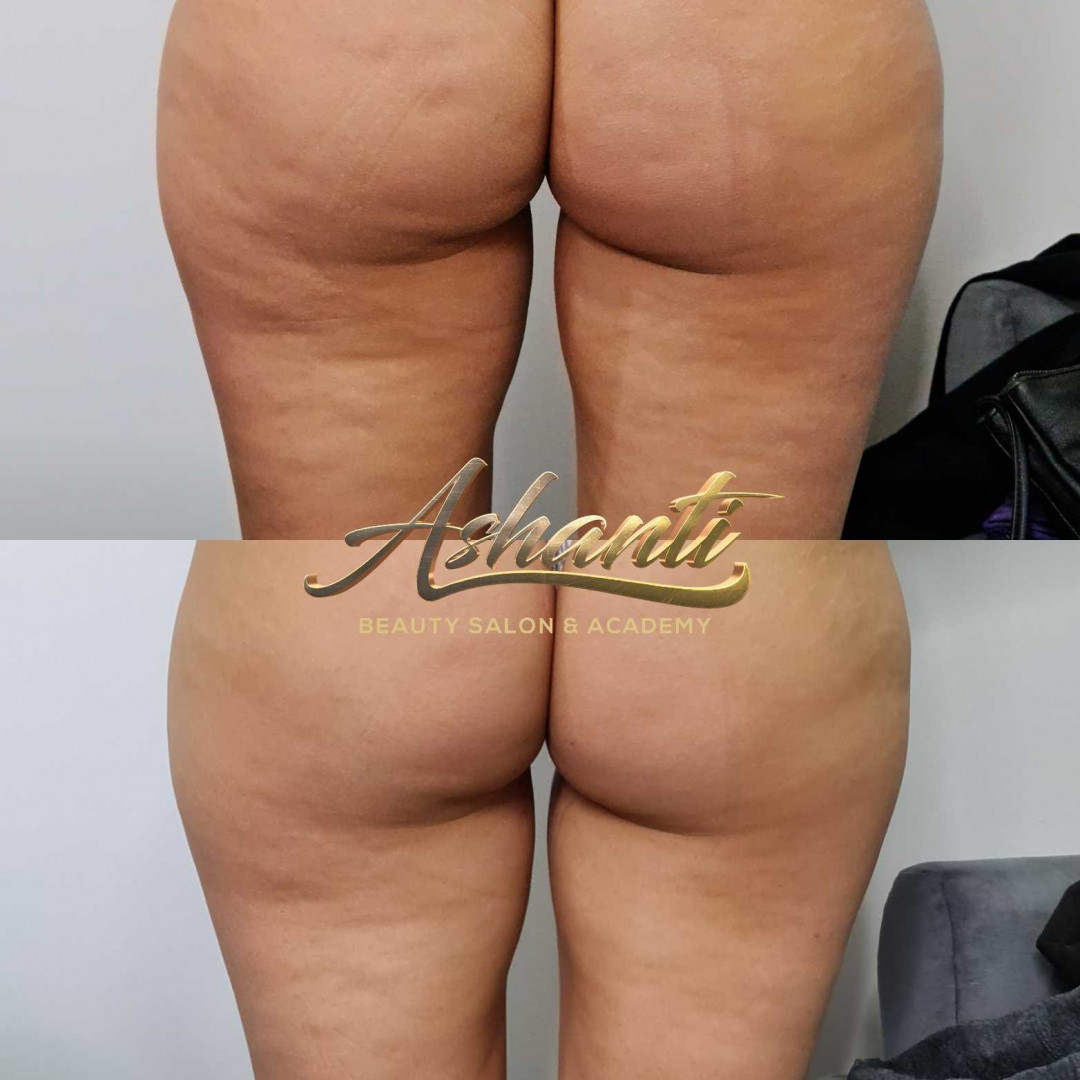 Ashanti Beauty Salon & Academy #beograd Tretmani tela Ultrazvučna kavitacija + radiotalasni lifting - po regiji
