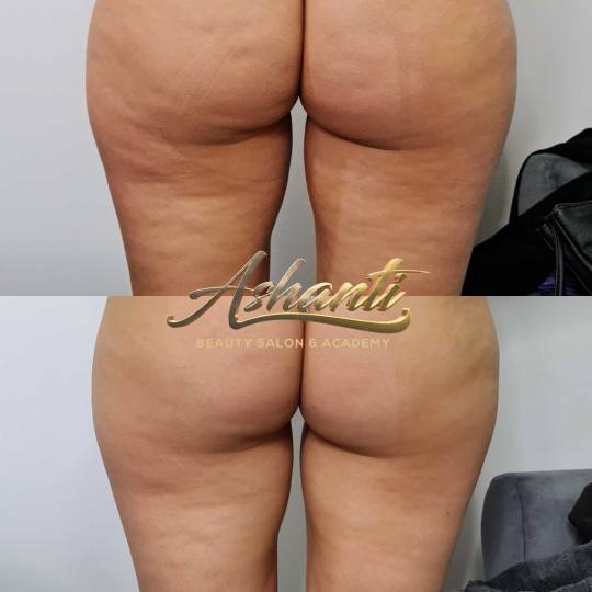 Ashanti Beauty Salon & Academy #beograd Tretmani tela Ultrazvučna kavitacija + radiotalasni lifting