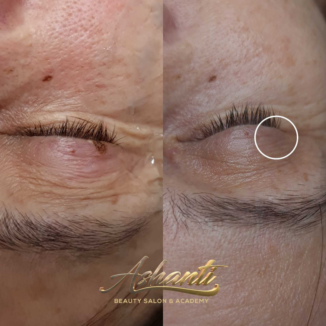 Uklanjanje virusnih bradavica - Ashanti Beauty Salon & Academy, Beograd Tretman lica Lice Tretman lica, Beograd, Voždovac