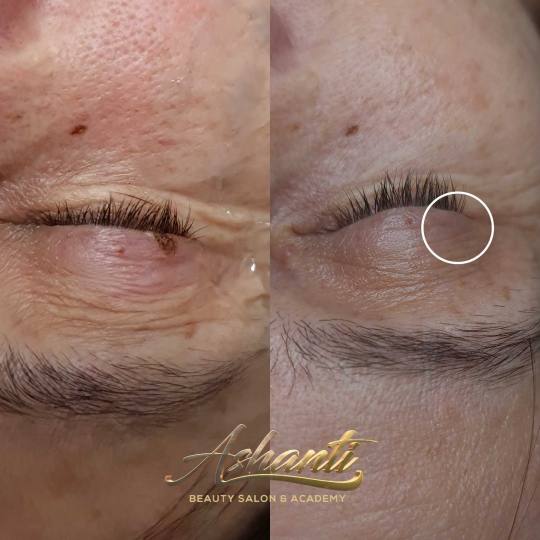 Ashanti Beauty Salon & Academy #beograd Tretman lica Uklanjanje virusnih bradavica