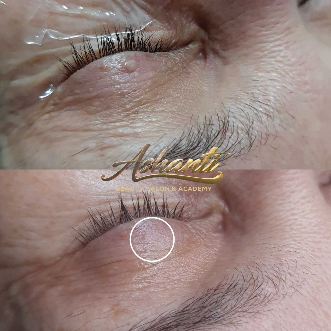 Uklanjanje virusnih bradavica - Ashanti Beauty Salon & Academy, Beograd Tretman lica Lice Tretman lica, Beograd, Voždovac