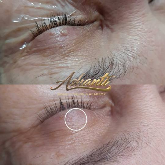 Ashanti Beauty Salon & Academy #beograd Tretman lica Uklanjanje virusnih bradavica