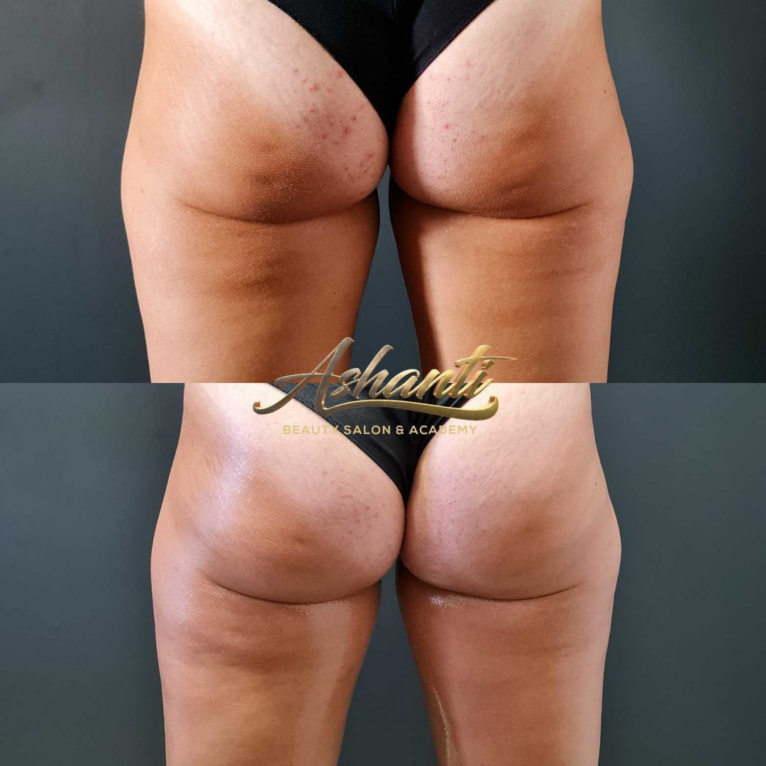Ashanti Beauty Salon & Academy #beograd Masaža za mršavljenje Dermapen - regija lica