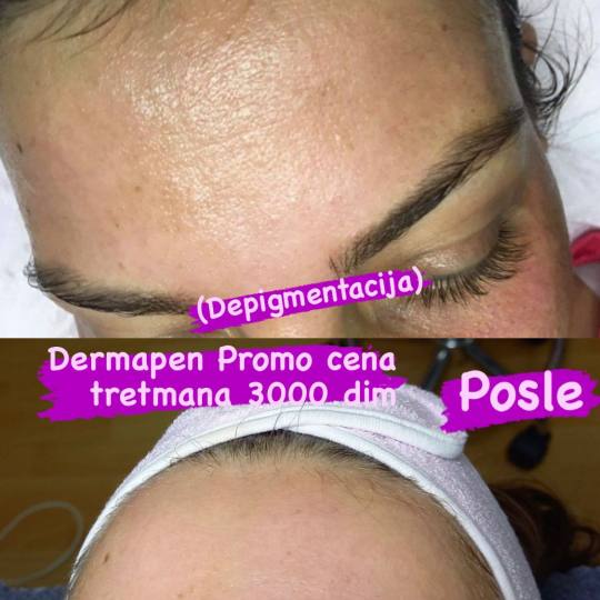 Plavi Anđeo #beograd Dermaroler i dermapen
