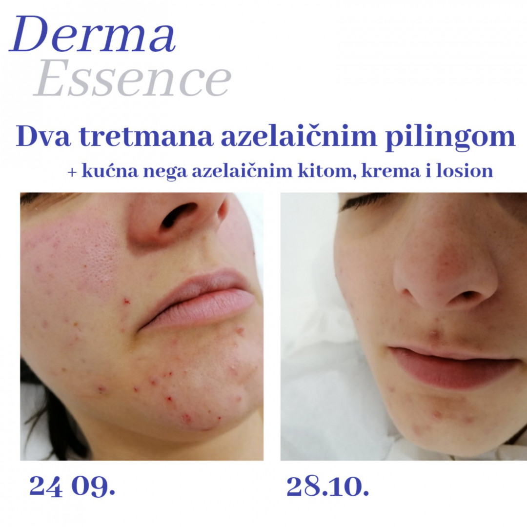 Derma Essence #nis Tretman lica Azelaični piling, Salicilni ili Laktobionski