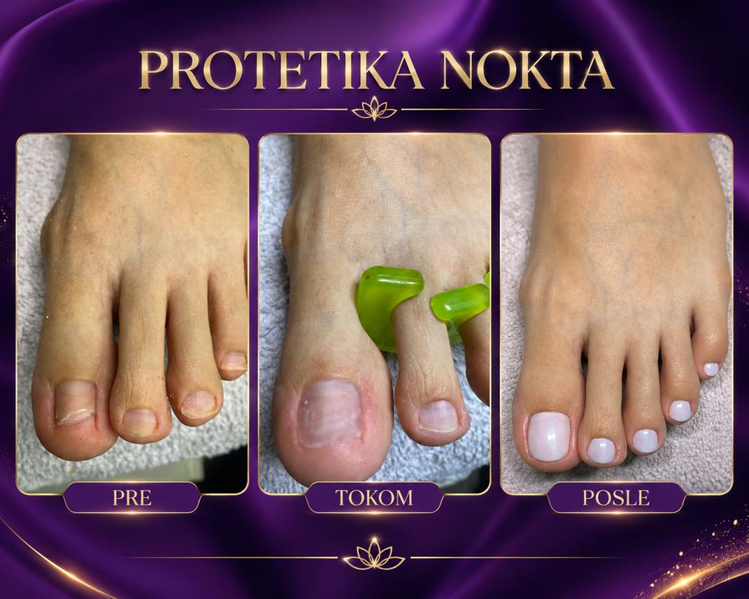 PROTETIKA JEDNOG NOKTA - Fenix, Beograd Manikir Nokti Manikir, Beograd, Dušanovac, Šumice