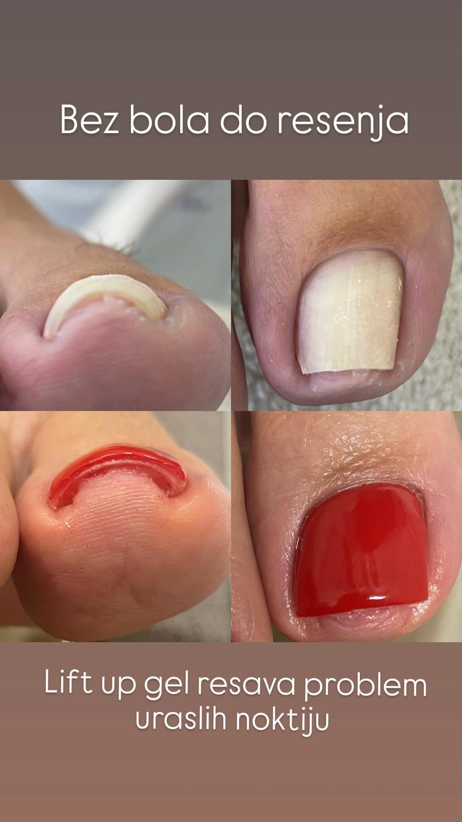 Lift up gel - po noktu - Manikir Prestige, Kraljevo Medicinski pedikir Nokti Medicinski pedikir, Kraljevo, Centar