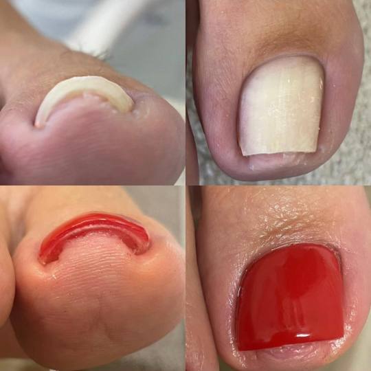 Manikir Prestige #kraljevo Medicinski pedikir Lift up gel - po noktu