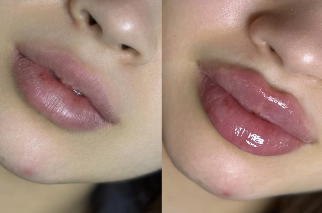 Estetik beauty centar #pancevo Tretman lica Hijaluronski filer iglom-1 cc