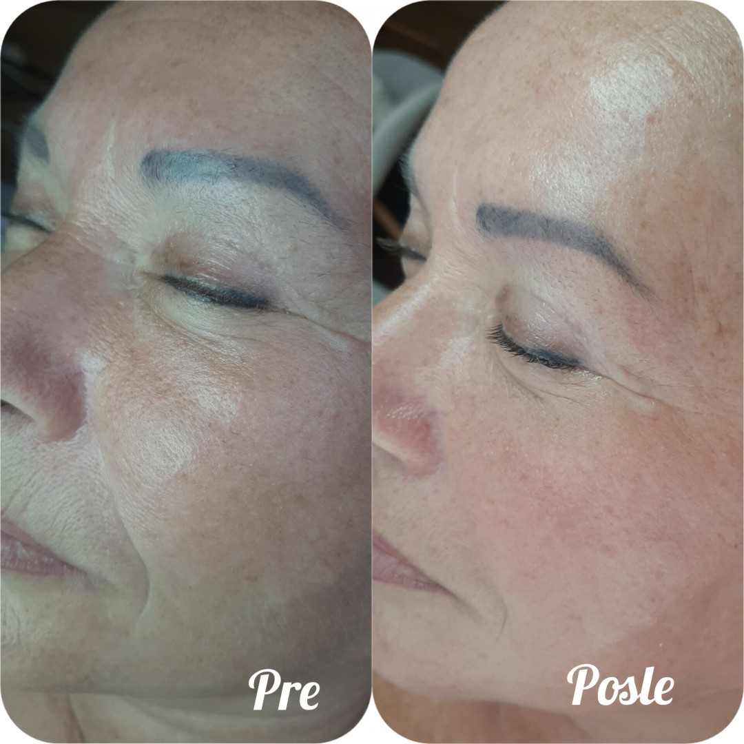 Studio Venera J #beograd Tretman lica Derma Fix tretman lica sa kolagenskim nitima