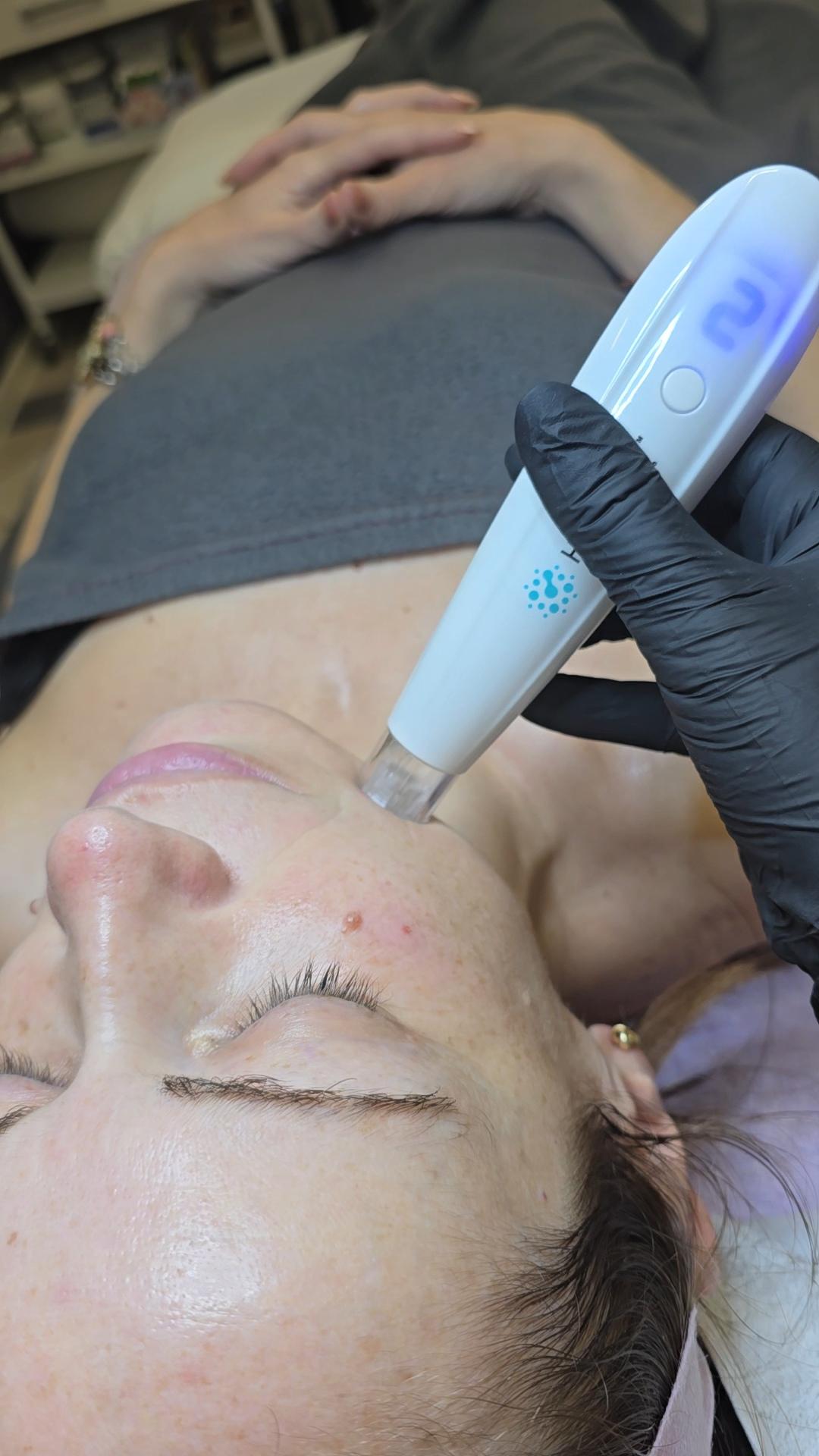 Laser lab by Ceca #novisad Tretmani protiv bora Dermapen + mezoterpija mikroiglicama - hijaluronska kiselina + kolagen + koktel vitamina