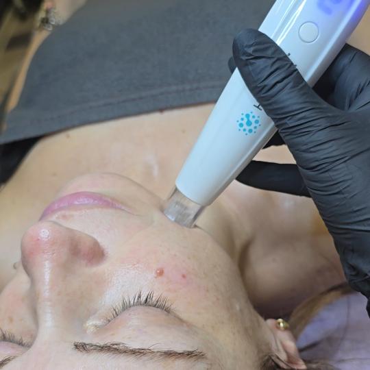 Laser lab by Ceca #novisad Tretmani protiv bora Dermapen + mezoterpija mikroiglicama - hijaluronska 