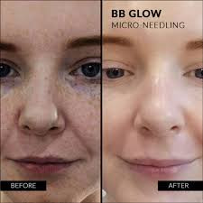 Vila Beauty Studio #beograd Tretman lica BB Glow tretman lica - do 10 dana