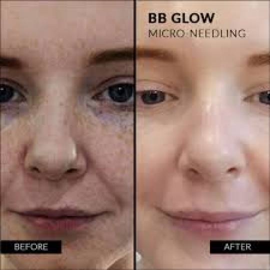Vila Beauty Studio #beograd Tretman lica BB Glow tretman lica - do 10 dana