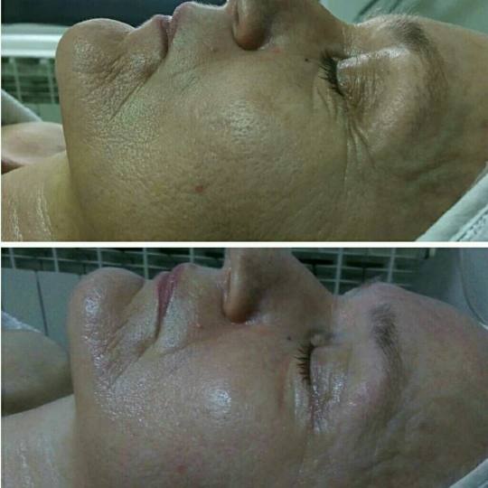 Look at me #beograd Tretmani protiv bora 3D Wrinkle tretman lica Nakon drugog tretmana