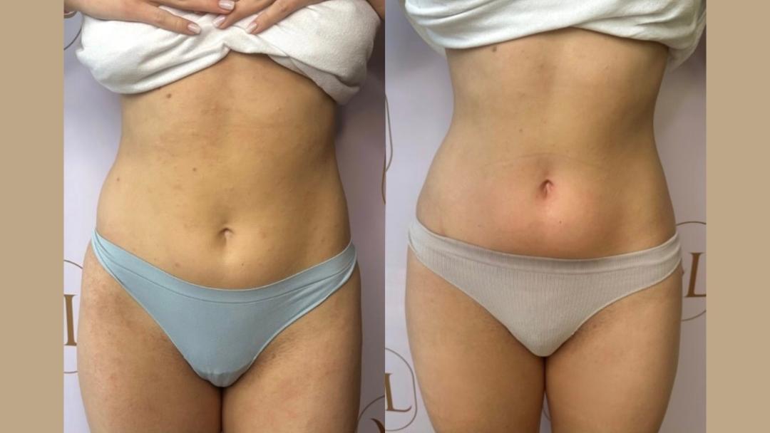 Personalizovani Attento tretmani tela - paket od 6 tretmana - Attento Aesthetic, Beograd Tretmani tela Telo Tretmani tela, Beograd, Zvezdara