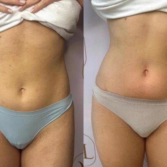 Attento Aesthetic #beograd Tretmani tela Personalizovani Attento tretmani tela - paket od 6 tretmana