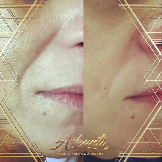 Ashanti Beauty Salon & Academy #beograd Tretman lica Plasma pen - nazolabijalne bore