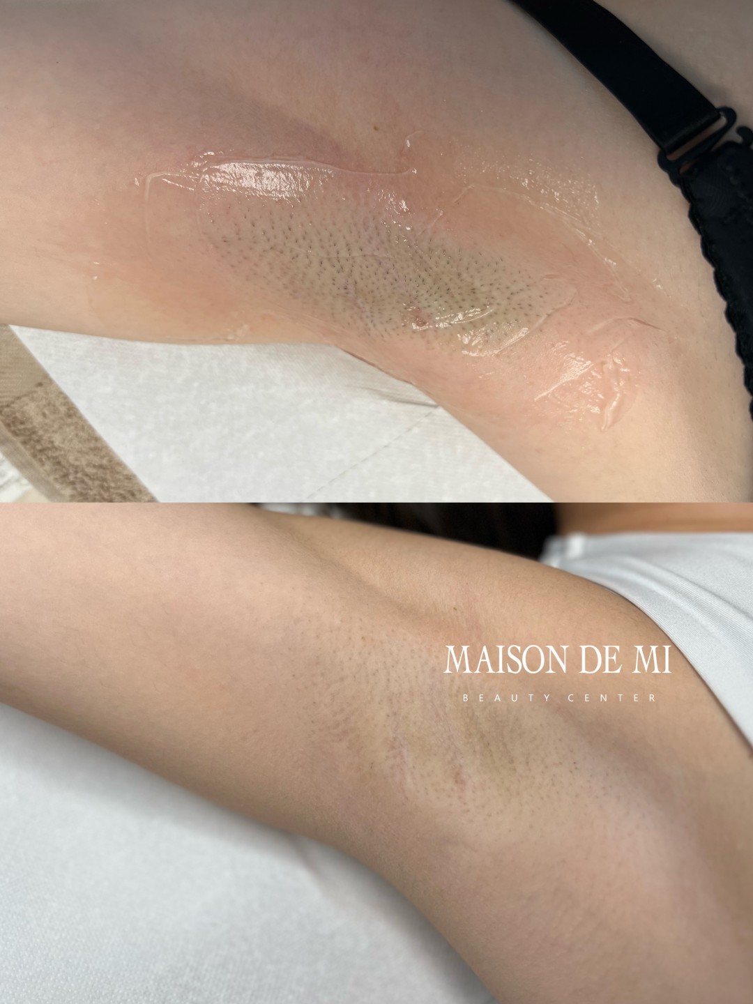 Maison de mi #beograd Laserska epilacija Laserska epilacija pazuha - za dame